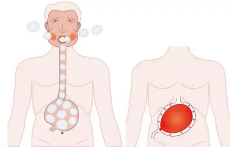 Belching, Bloating graphic