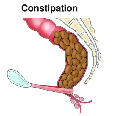 Constipation graphic