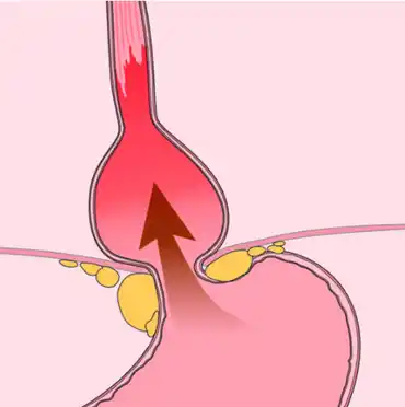 Heartburn illustration