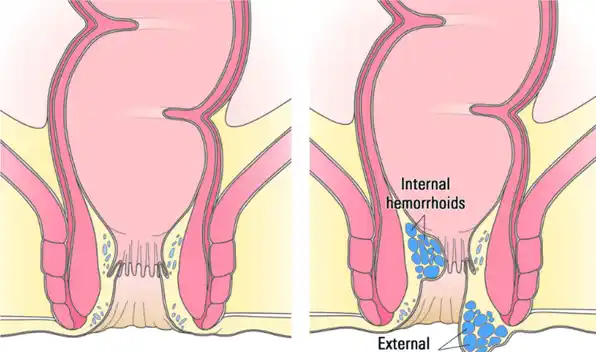 Hemorrhoids graphic