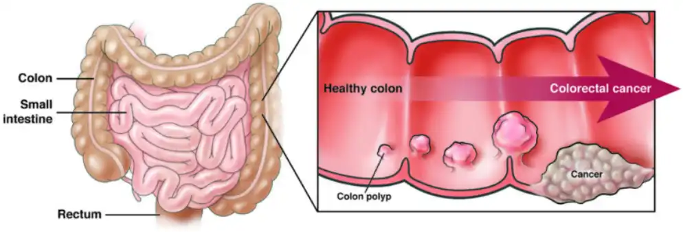 colorectal image web